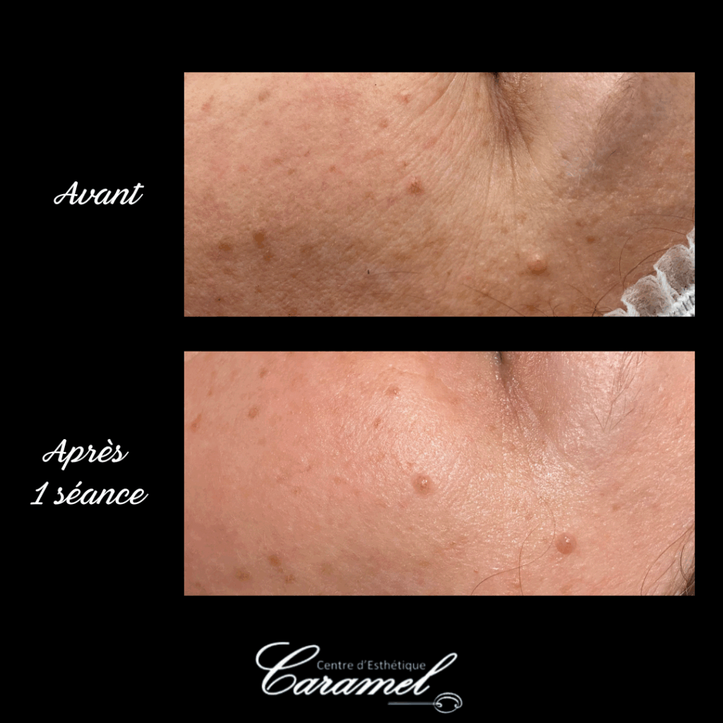 Avant après Aurélie Soin visage anti âge Starvac 1