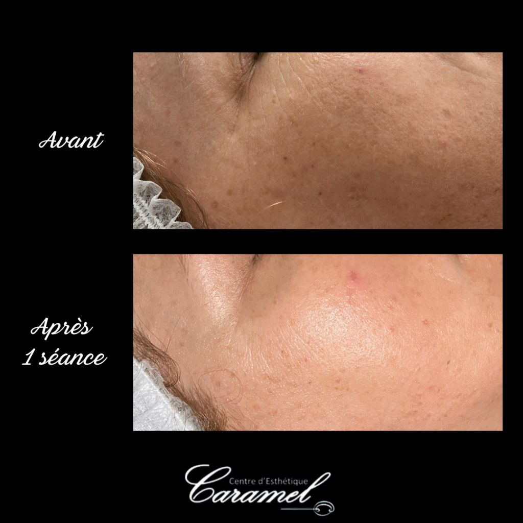 Avant après Aurélie Soin visage anti âge Starvac 2