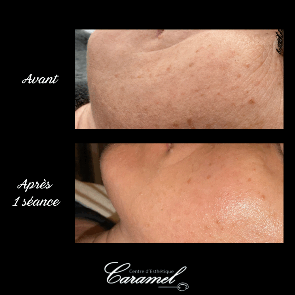 Avant après Aurélie Soin visage anti âge Starvac 3