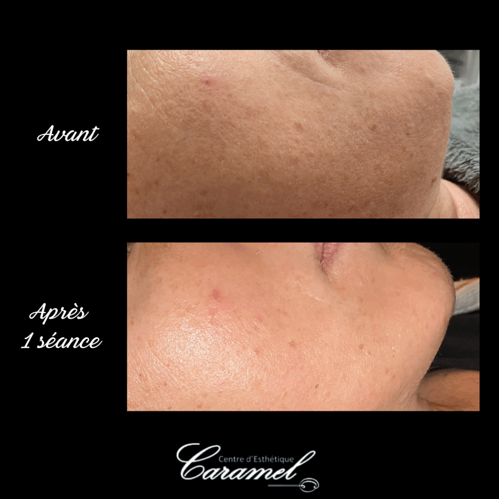 Avant après Aurélie Soin visage anti âge Starvac 4