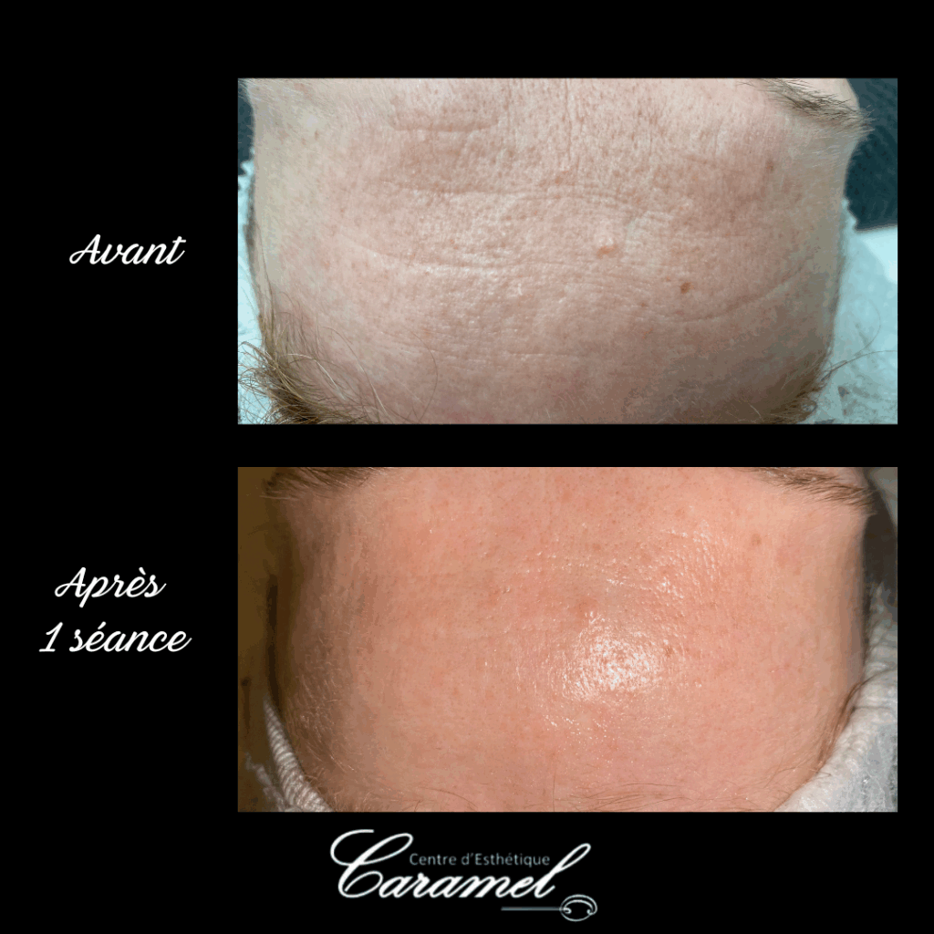 Avant après Aurélie Soin visage anti âge Starvac 5