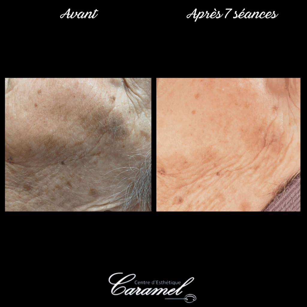 Avant après photo-rajeunissement 15