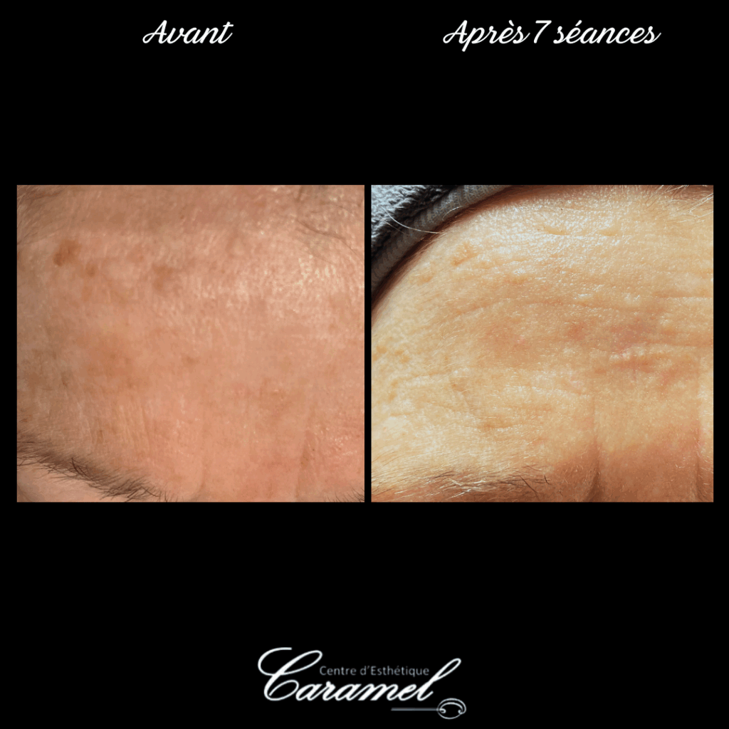 Avant après photo-rajeunissement 20