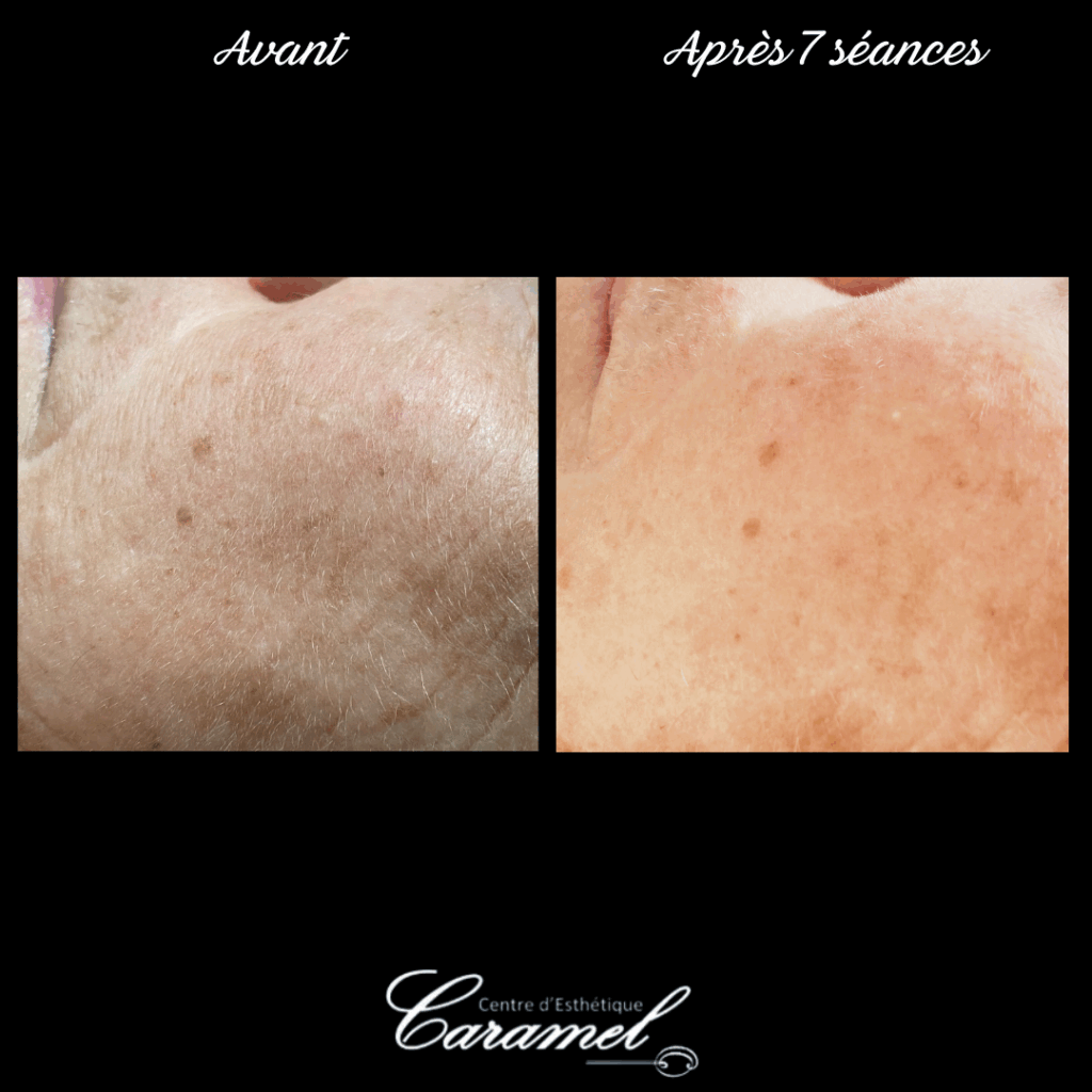 Avant après photo-rajeunissement 30