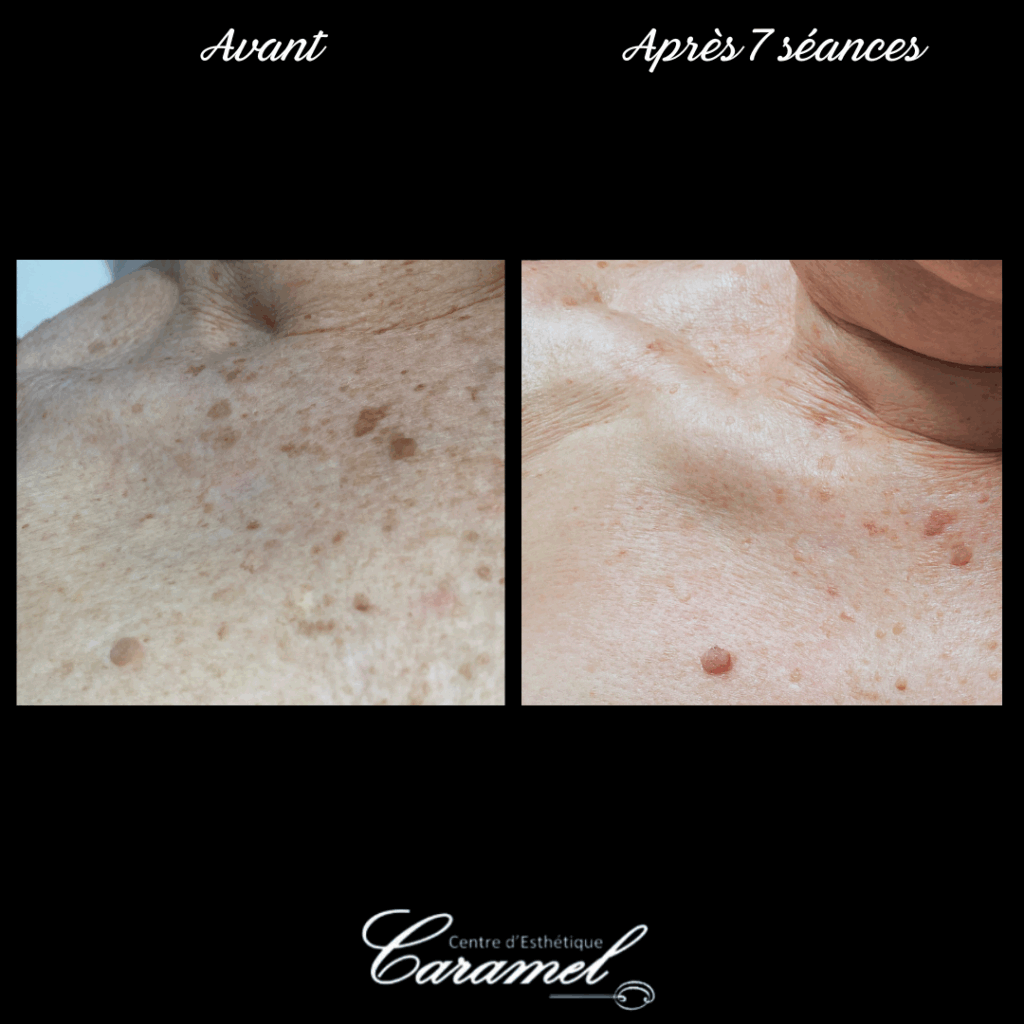 Avant après photo-rajeunissement 34