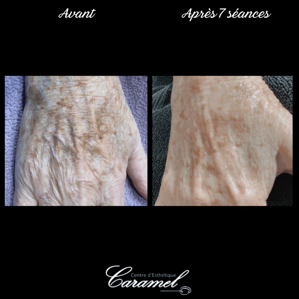 Avant après photo-rajeunissement 5