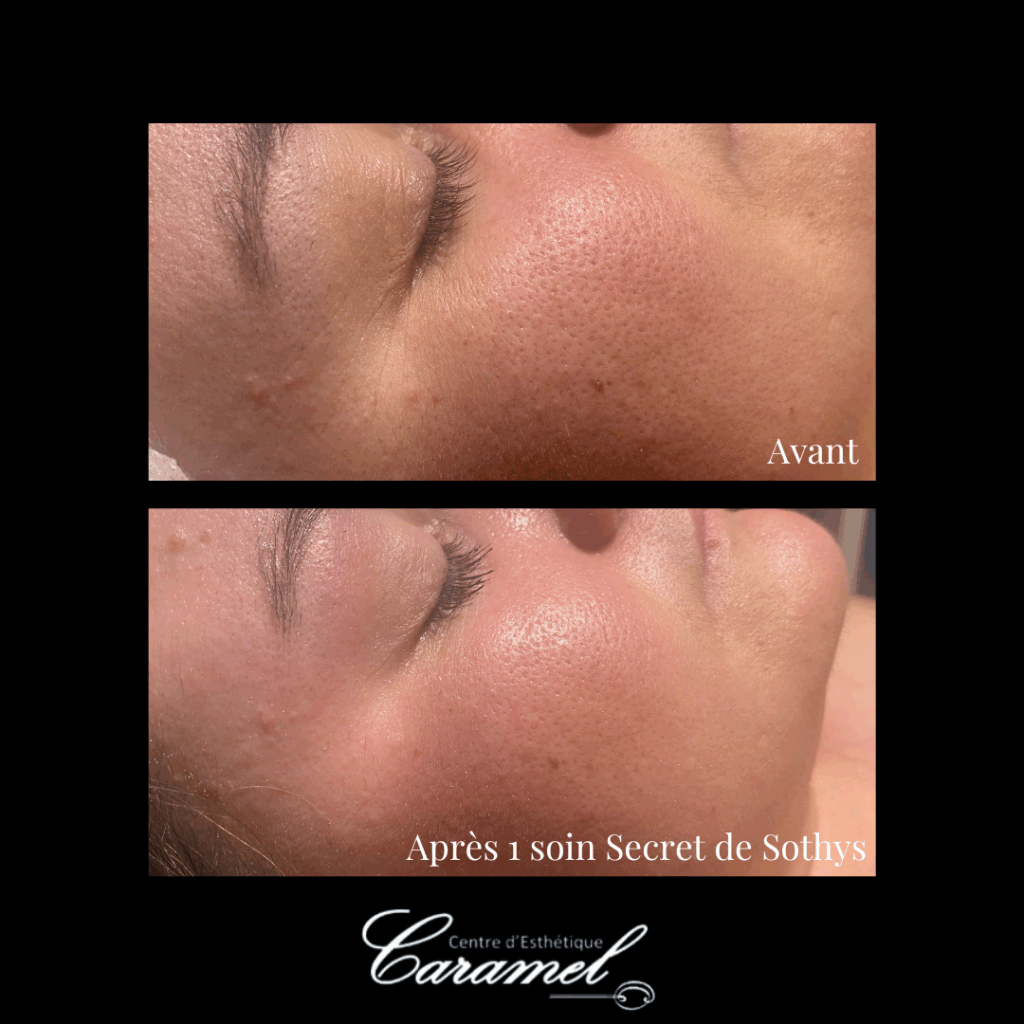 Avant après soin visage manuel secret de Sothys 2