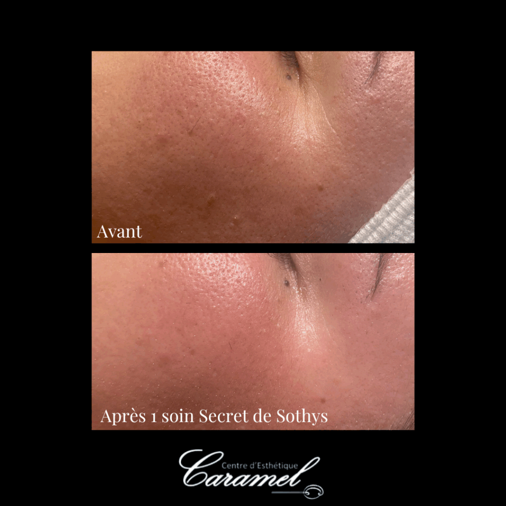 Avant après soin visage manuel secret de Sothys 3