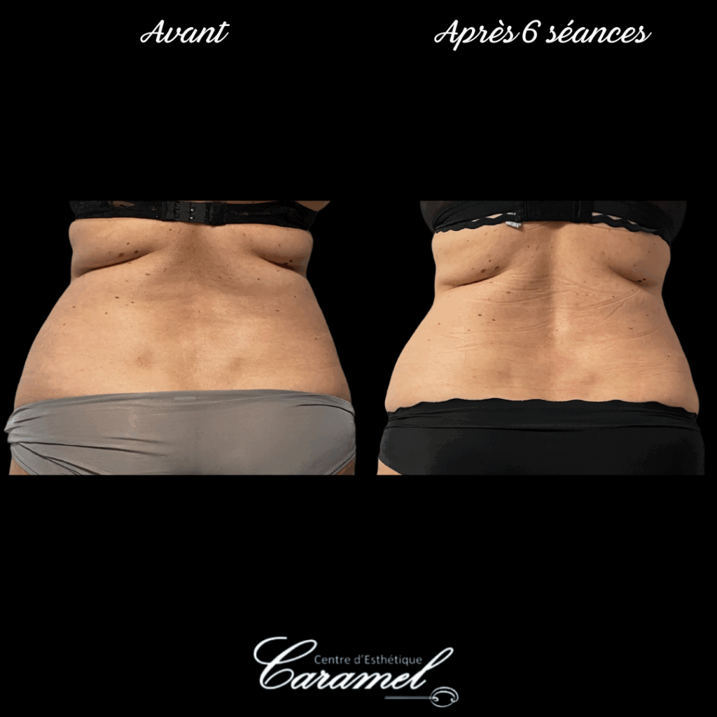 avant après adipologie 11