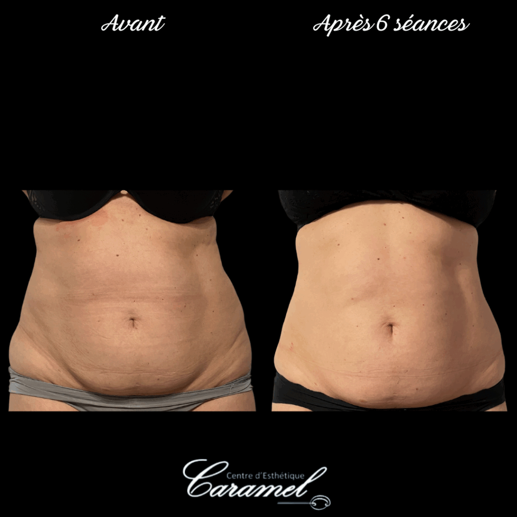 avant après adipologie 2