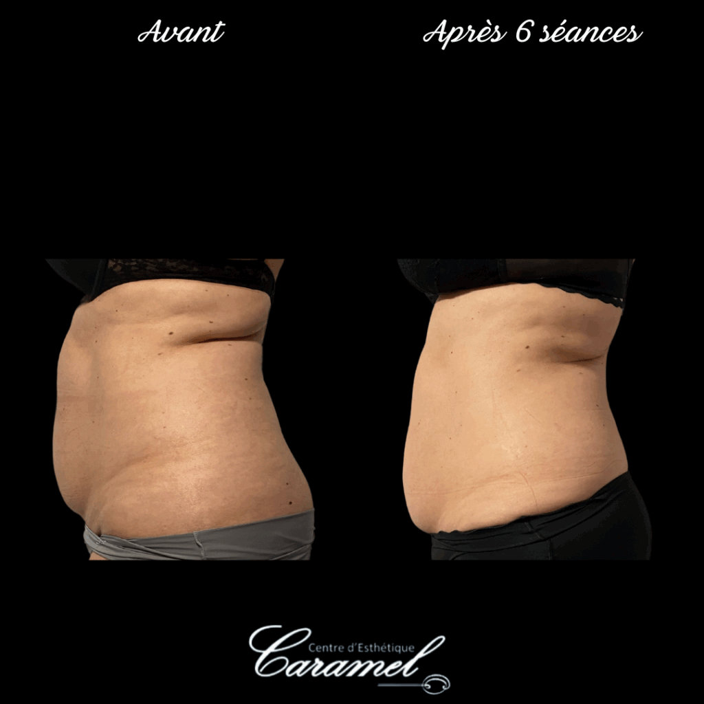 avant après adipologie 5