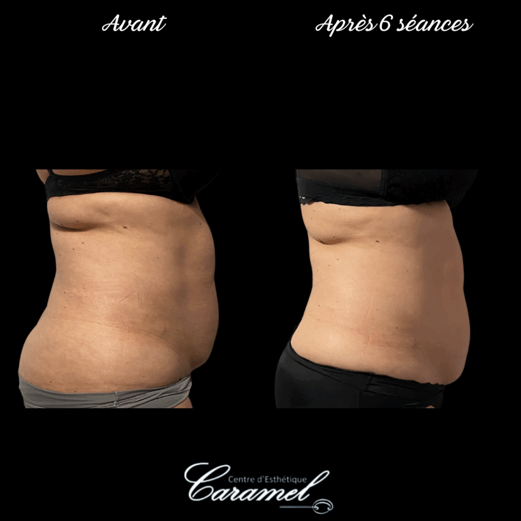 avant après adipologie 8