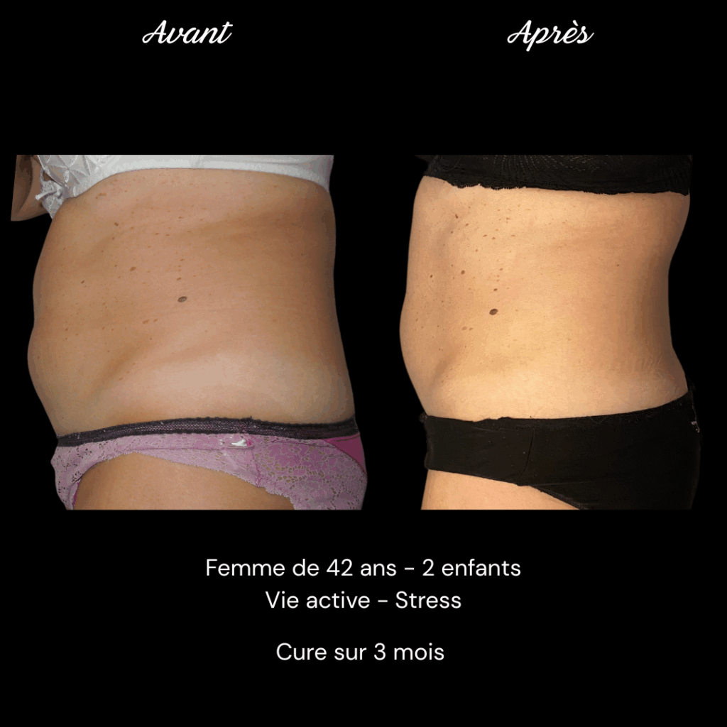 Avant Après Adipologie Marie Pierre G (2)
