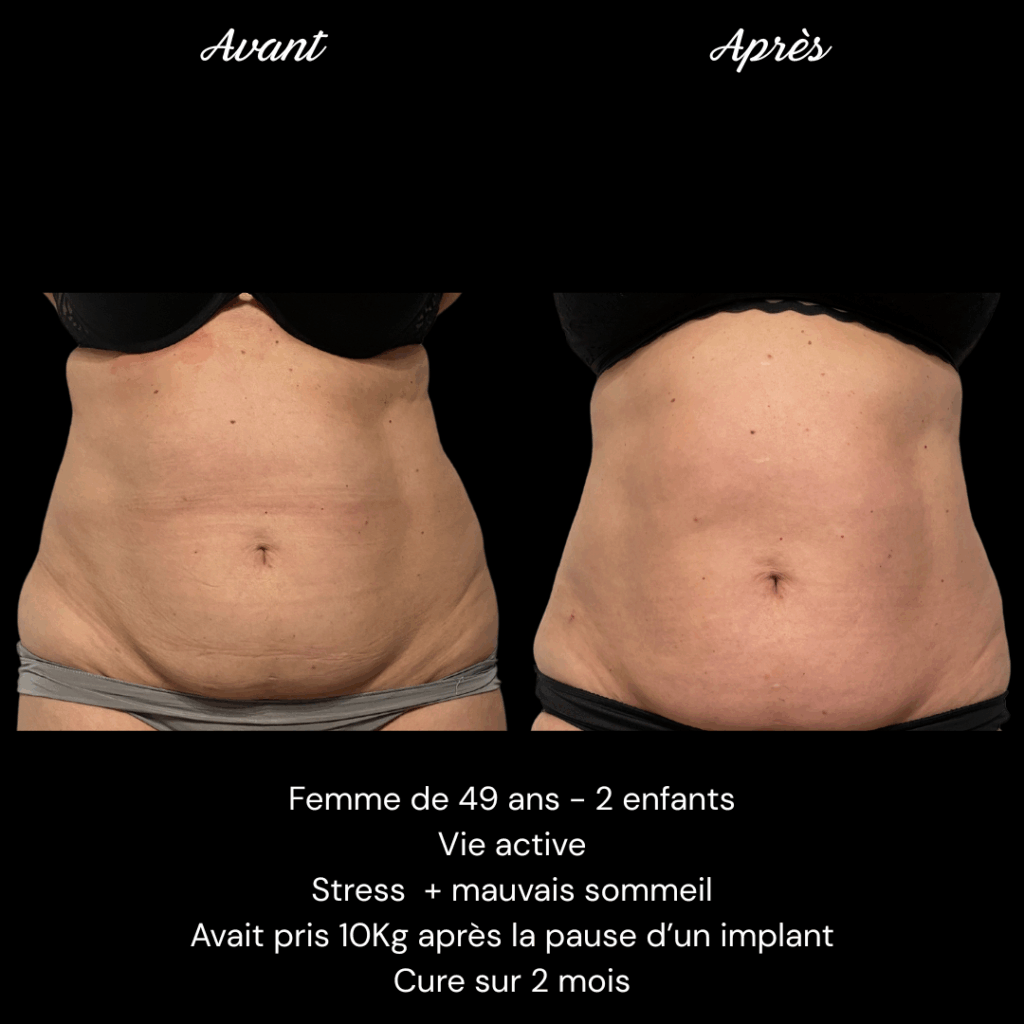 Avant Après Adipologie PERRIER (1)