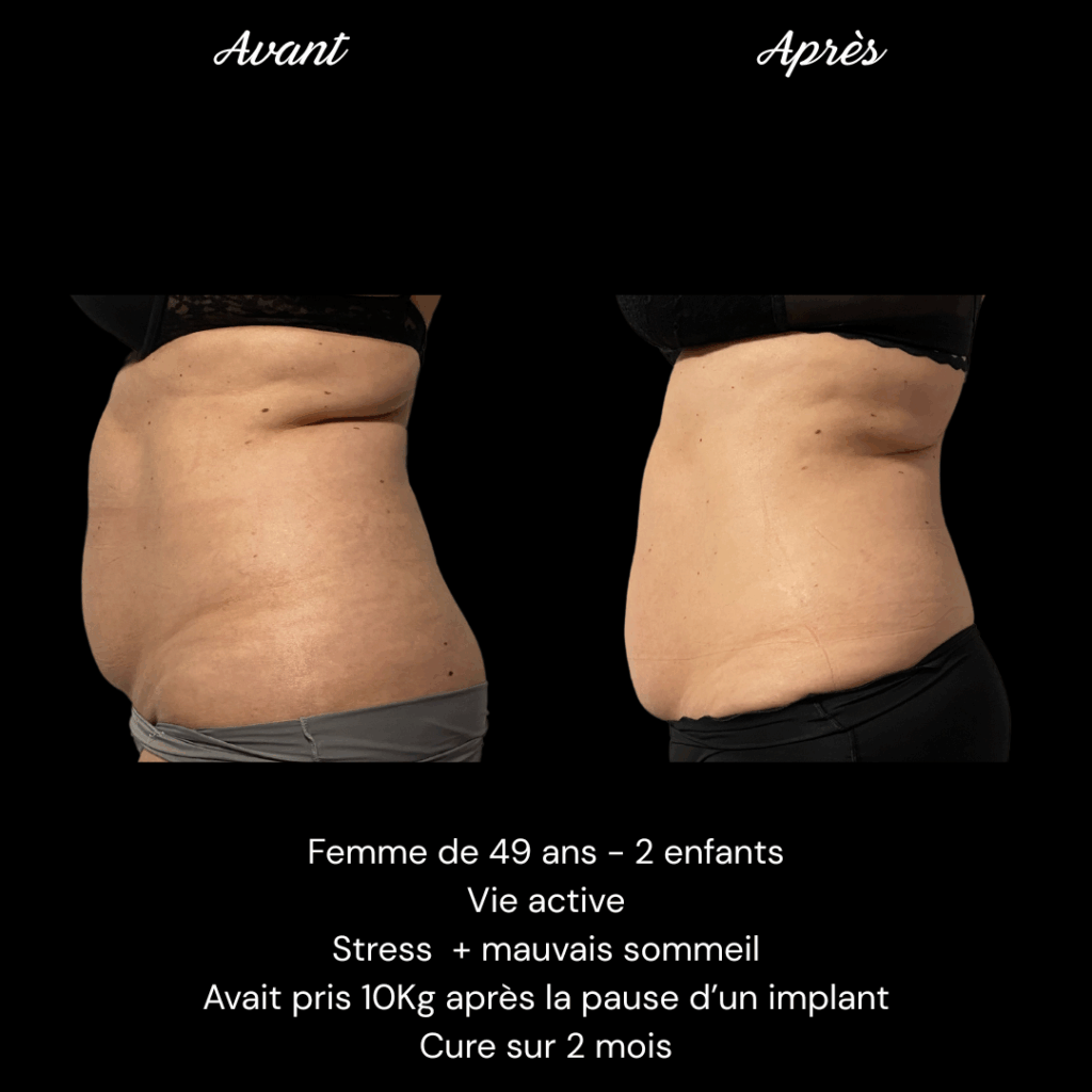 Avant Après Adipologie PERRIER