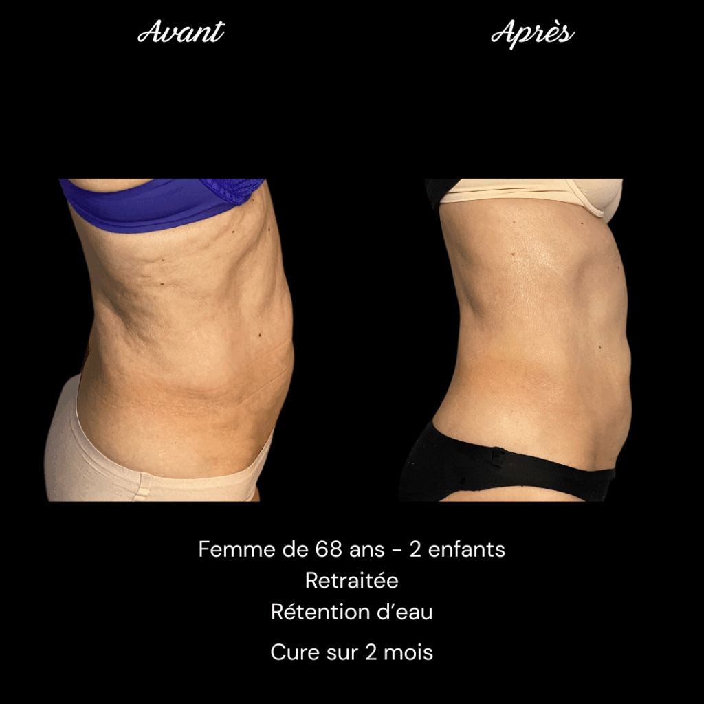 Copie de Avant Après Adipologie Annie A (1)