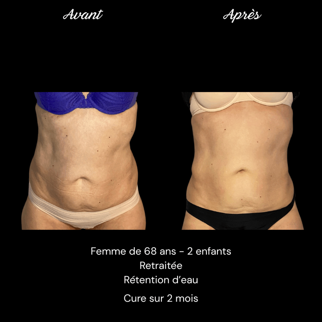 Copie de Avant Après Adipologie Annie A