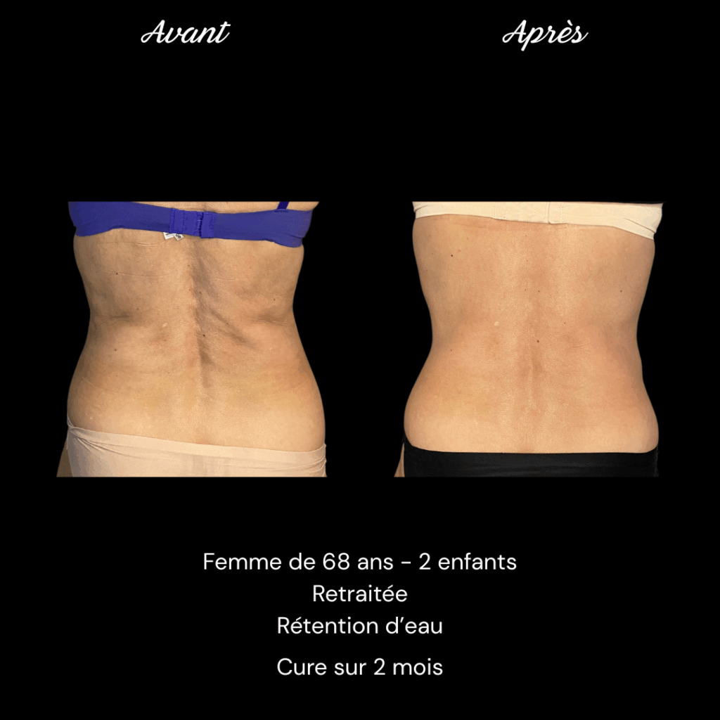 Copie de Avant Après Adipologie Annie A (2)