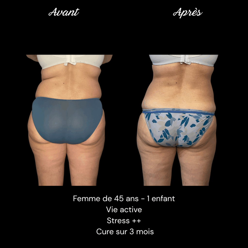 Cure-minceur-ventre-cuisses-1