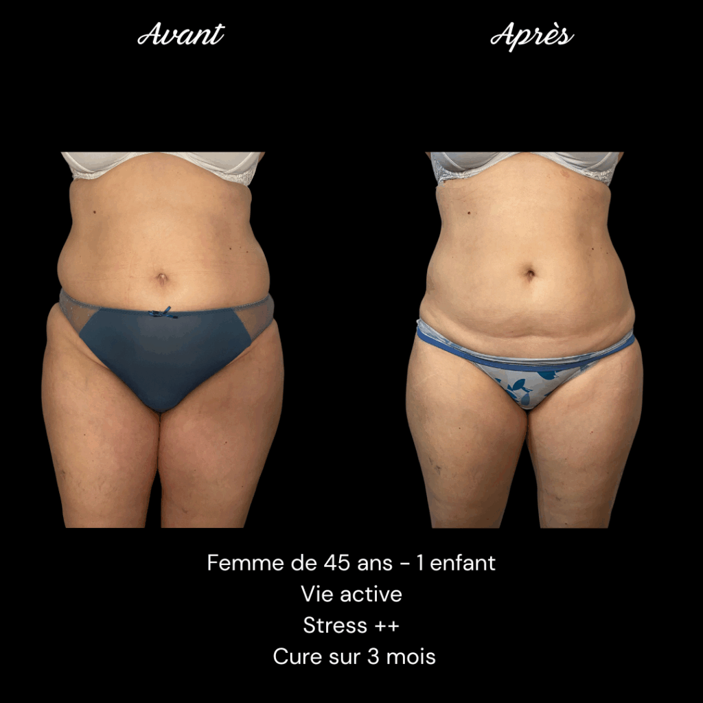 Cure-minceur-ventre-cuisses