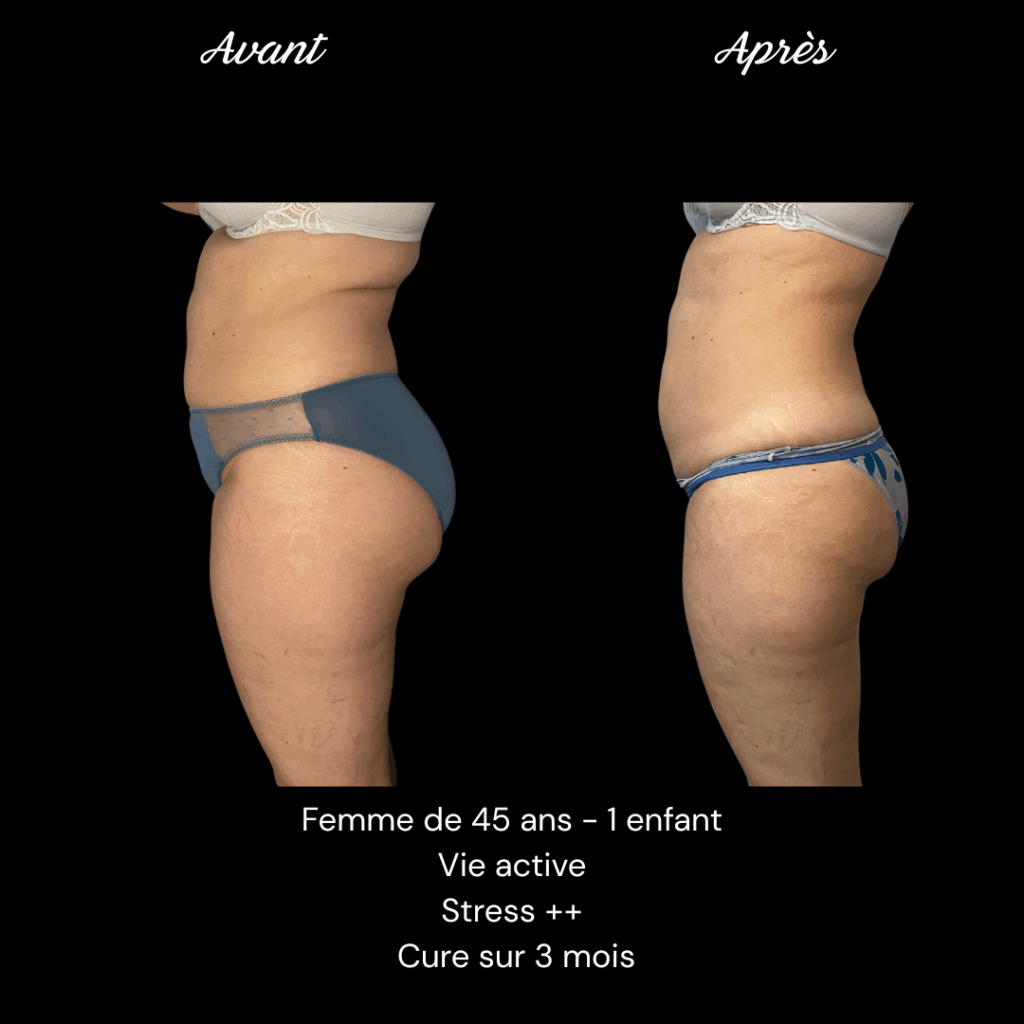 Cure-minceur-ventre-cuisses-2