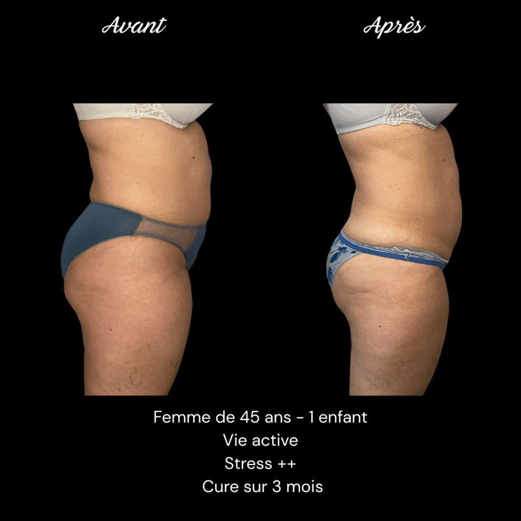Cure-minceur-ventre-cuisses-3