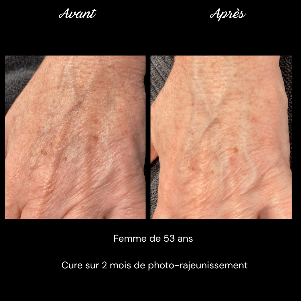 photo-rajeunissement-anti-age-soin-mains1