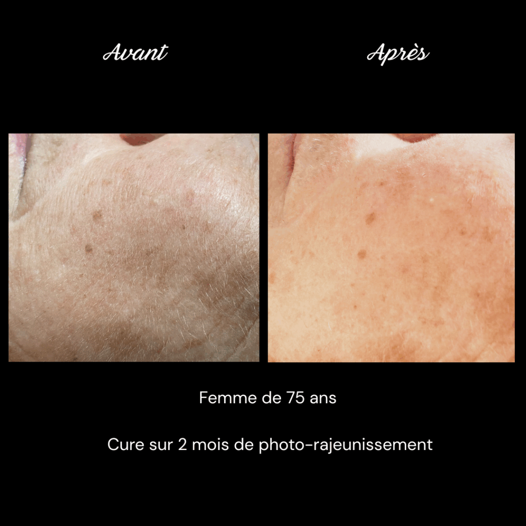photo-rajeunissement-anti-age-soin-visage3