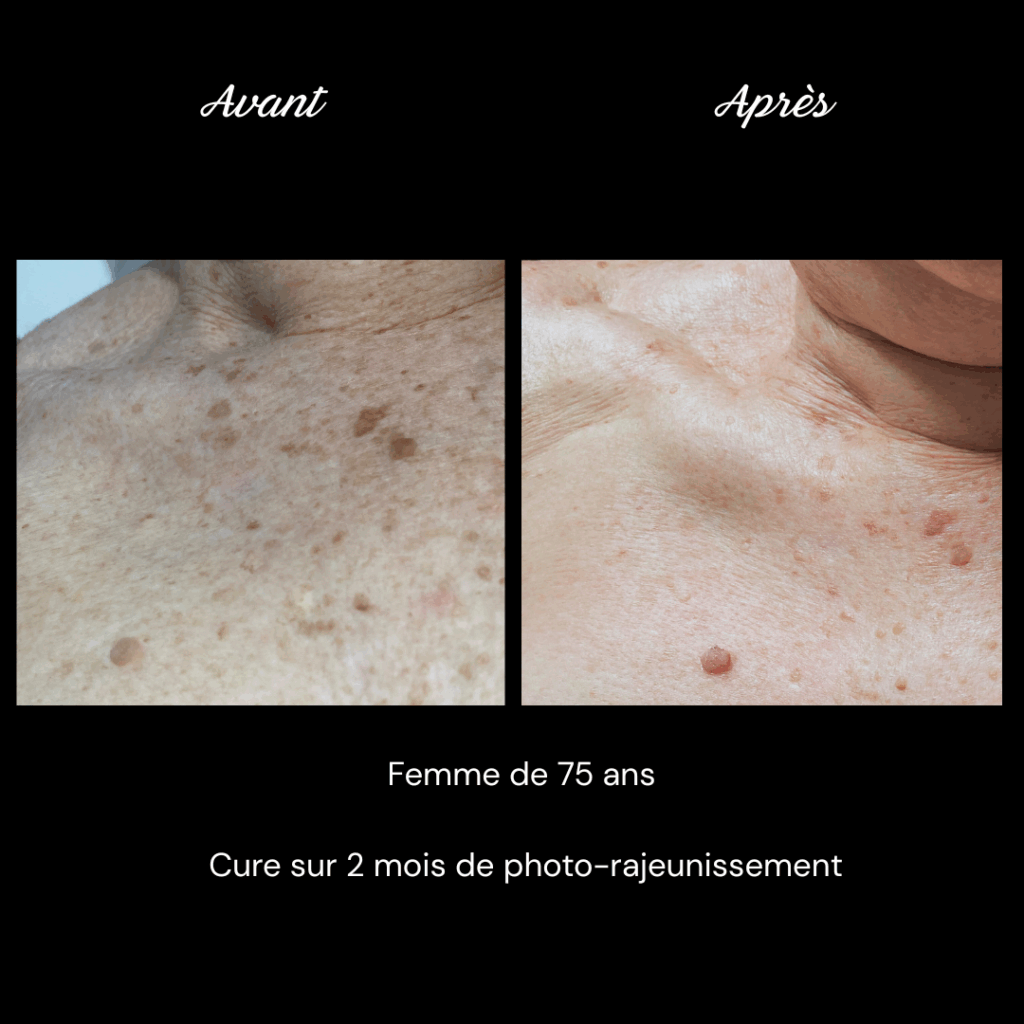 photo-rajeunissement-anti-age-soin-visage4